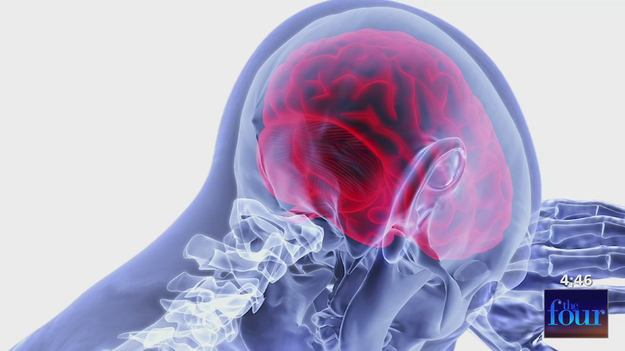 Health in Focus: The Causes, Effects and Treatments for Brain Bleeds ...